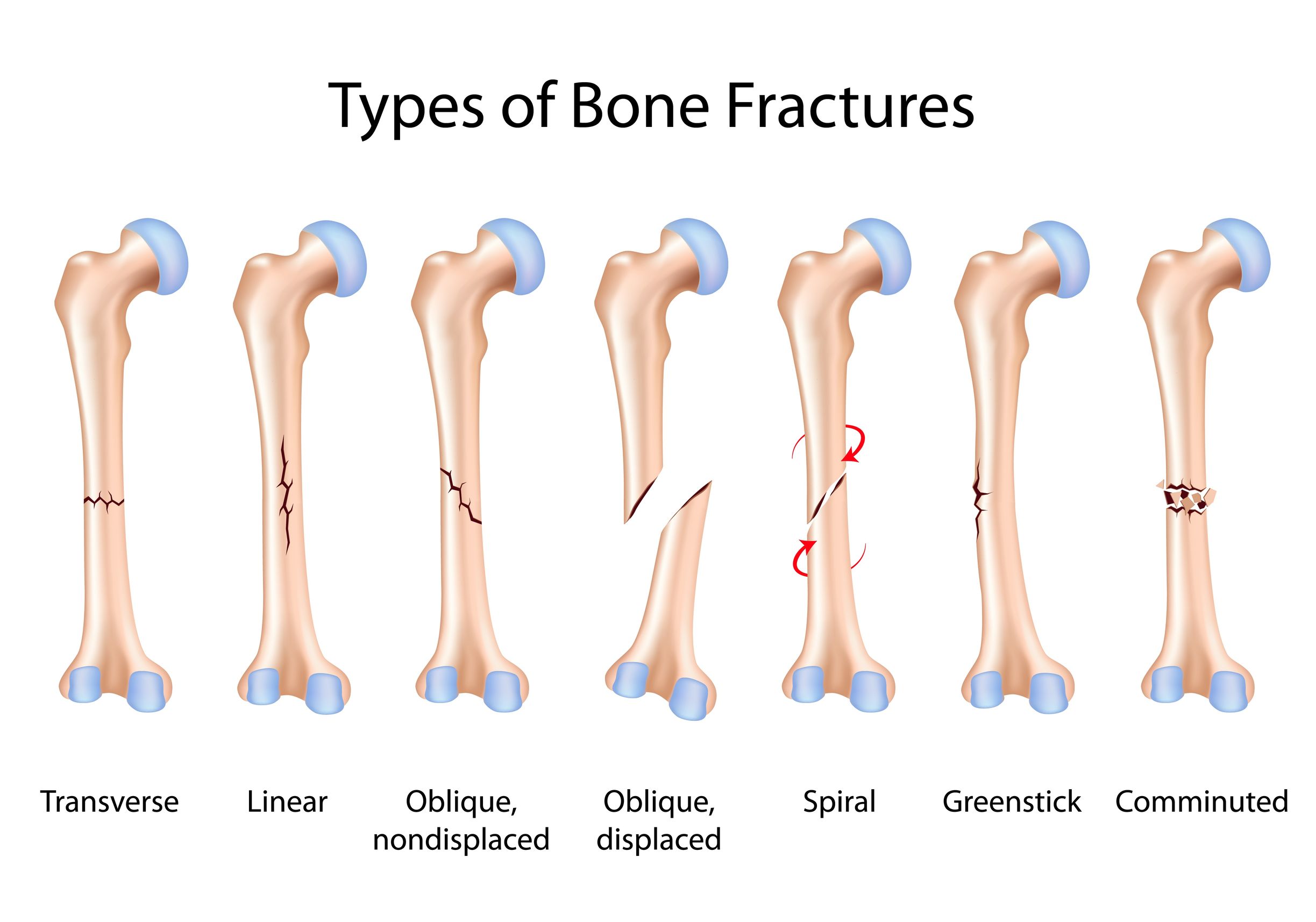 Types of Broken Bones: Symptoms, Treatment, Healing