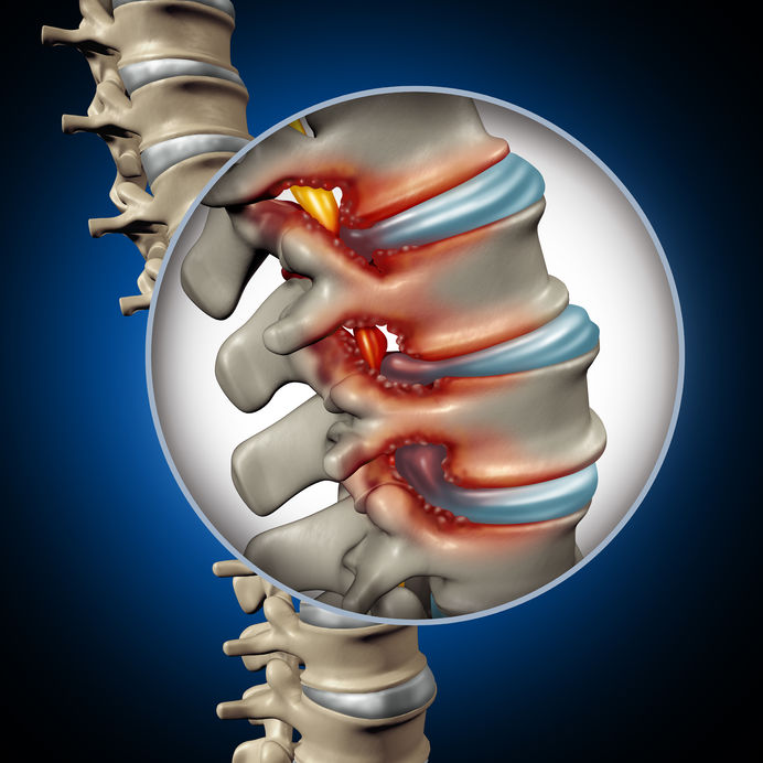 Can Spinal Stenosis Be Reversed?