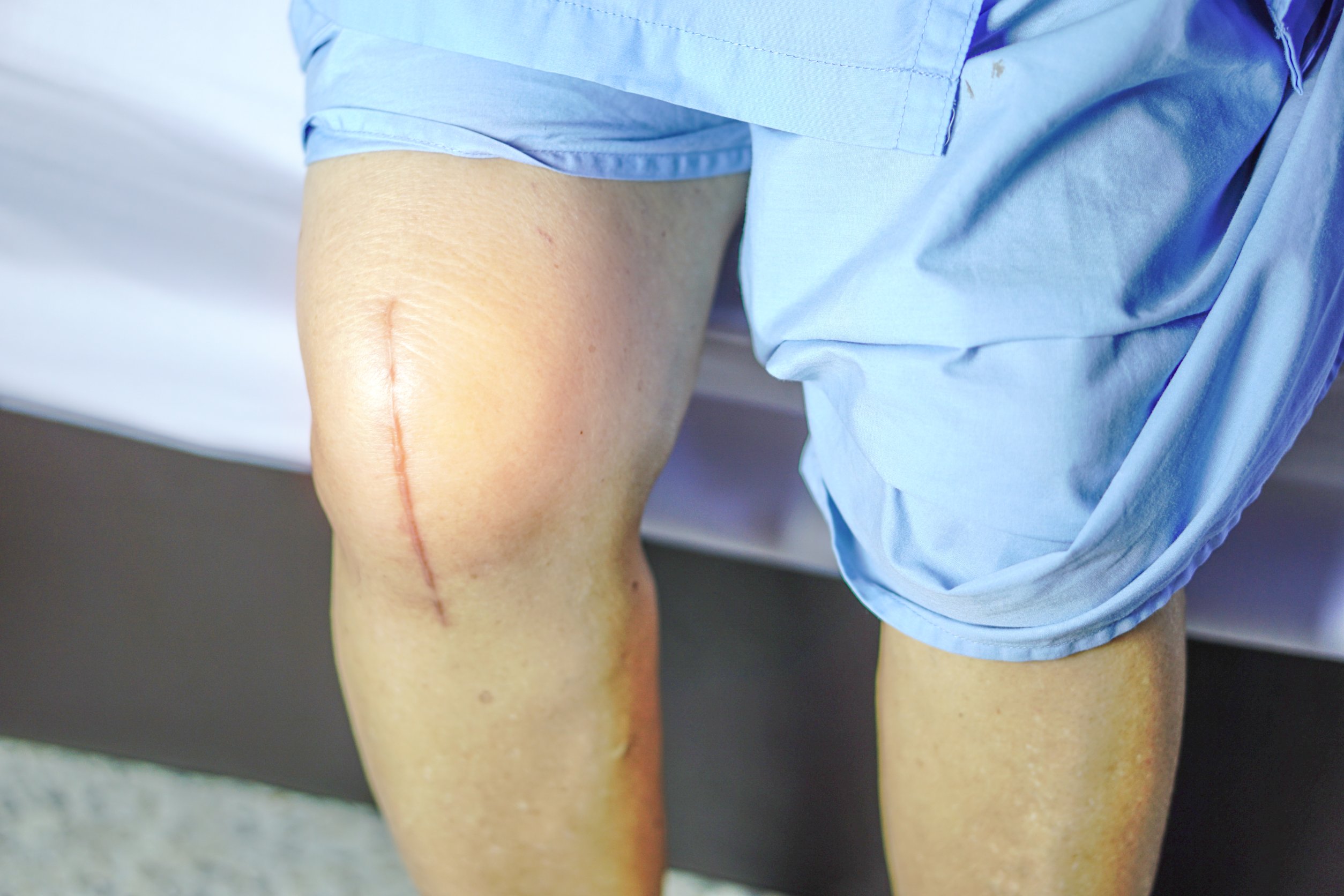 Will Knee Replacement Get Rid Of Arthritis?